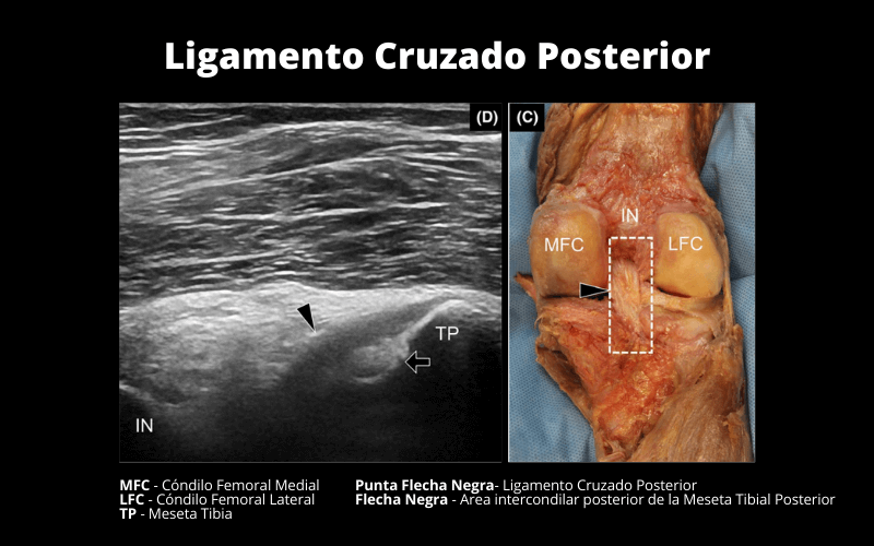 Ligamento Meniscofemoral Posterior Y Ligamento Cruzado Posterior Tempo Formaci N